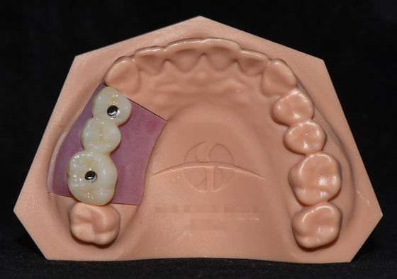 Mua Implant Porcelain hợp nhất với Zirconia Implant Crown Bridge Rất thẩm mỹ online manufacture