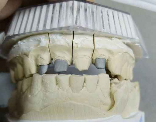 Mua Post Core Non Precious Metal Crown And Bridge Strong Strength Tùy chỉnh online manufacture