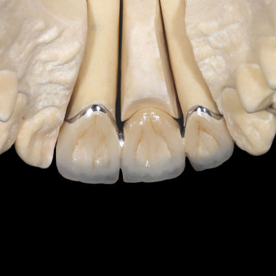 Mua Non Precious PFM Crown Implant Porcelain hợp nhất với Crown kim loại online manufacture