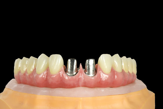 FDA Titanium Bridge Dental Implant Titanium Frame Với vương miện