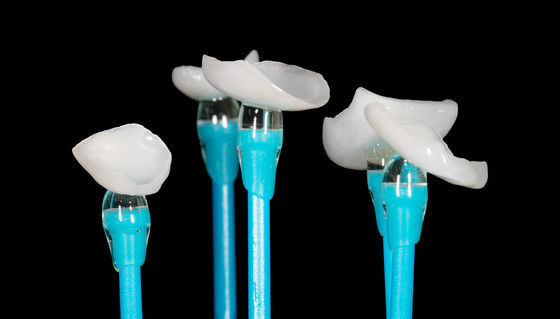 EMAX Pressed Onlay Veneer High Accuracy Dental Veneer Hoàn hảo