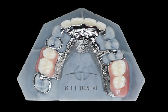 Titanium kim loại khung răng giả có thể tháo răng giả tùy chỉnh