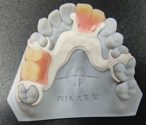 Tùy chỉnh Peek răng giả có thể tháo rời khung một phần chống mòn