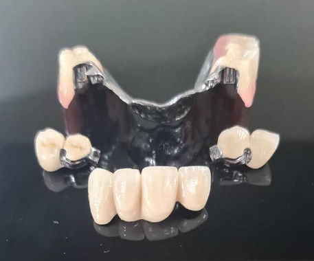 Kim loại khung chính xác đính kèm Overdenture răng giả có thể tháo răng giả