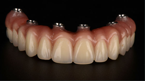 Tất cả trên X răng giả được hỗ trợ bằng cấy ghép Titanium Bridge Dental CE FDA chấp thuận