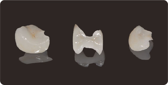 Độ chính xác răng Inlays và Onlays Lithium Disilicate Milling Onlay Veneer