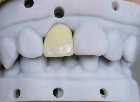 High Esthetics Composite Crown Onlay Veneer Kích thước tùy chỉnh