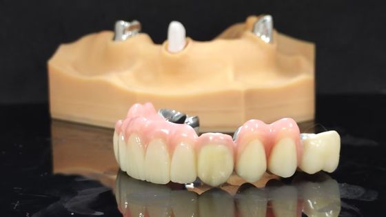 Vương miện và cầu Titanium có độ bền cao đối phó với composite