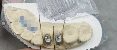 Kim loại / tự nhiên Ti nền vương miện Post Core Titan vương miện cho răng
