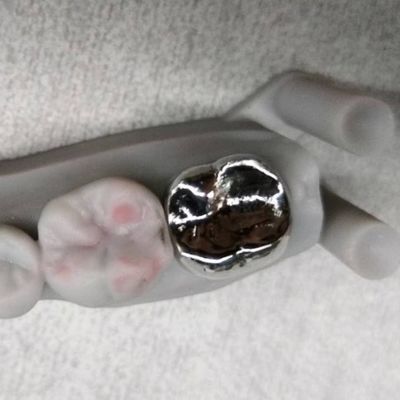 Vương miện kim loại đầy đủ và cầu cao độ chính xác Vương miện tạm thời bằng bạc