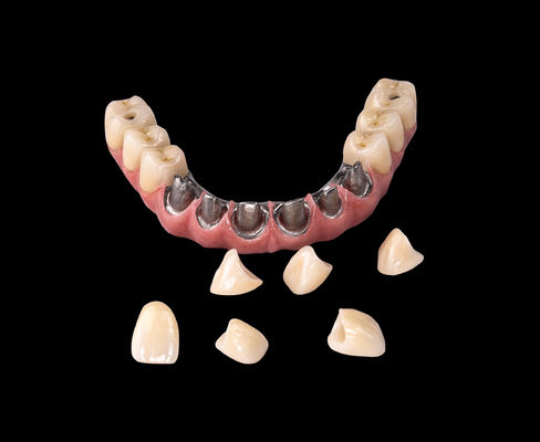Tất cả trên X cấy ghép Titanium cầu nha khoa chỉ khung chuyên nghiệp
