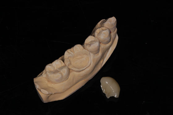 Dental Composite Onlay Veneer High Aesthetics Composite Veneer (Điều cao về thẩm mỹ)