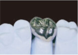 Vương miện kim loại đầy đủ và cầu cao độ chính xác Vương miện tạm thời bằng bạc